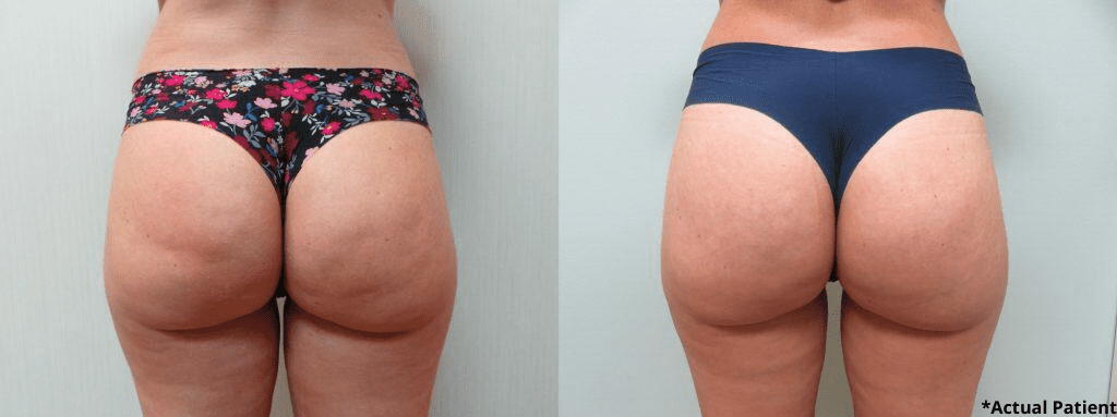 Avéli™ Cellulite Reduction Monterey CA