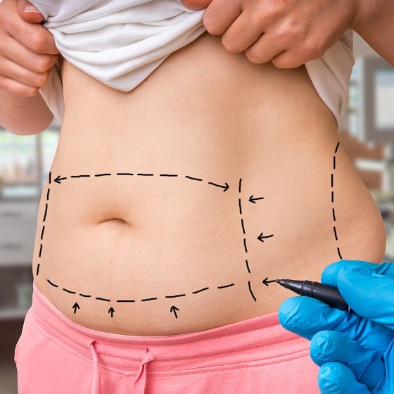 Abdominal Questions: Tummy tuck vs Liposuction