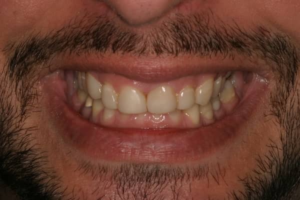 Sal G's Before and After Imaging with SNAP Instant Dental Imaging And Temporary