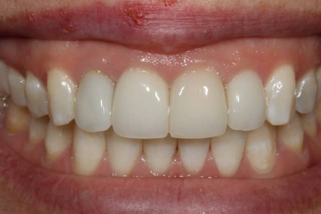 Immediate Implant Placement of a Single Central Incisor Using a CAD/CAMCrown-Root FormTechnique: Final Restoration