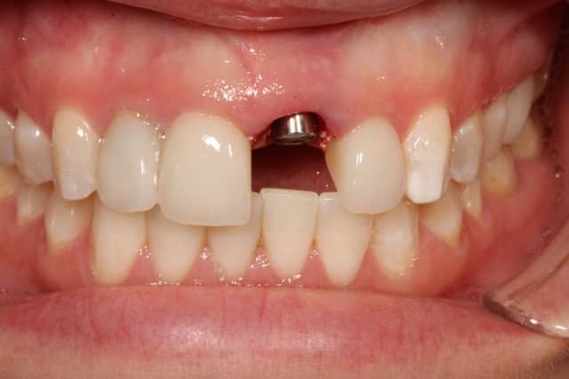 Immediate Implant Placement of a Single Central Incisor Using a CAD/CAMCrown-Root FormTechnique: Provisional