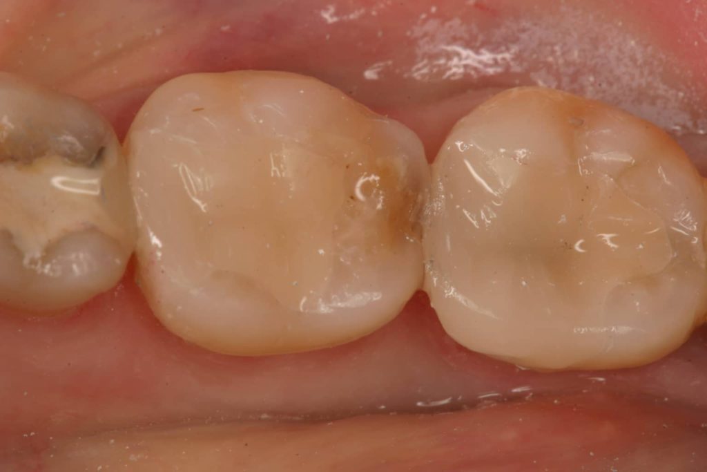Tooth colored filling