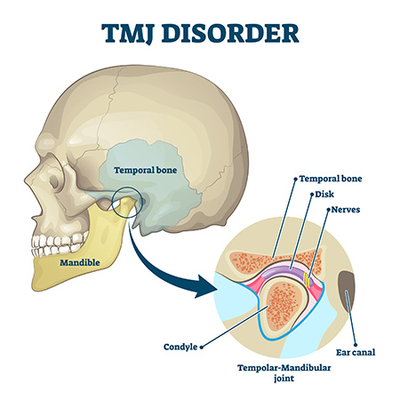 Tmj disorder