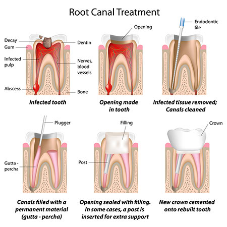 root canal dentist NYC