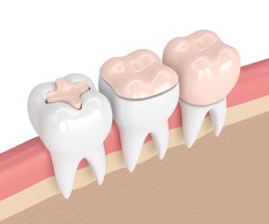 Digital rendering showing inlay, onlay, and dental crown restoration options.