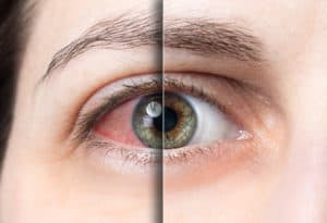 Dry Eye Treatment San Jose