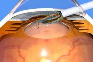 Cataract surgery in Castro Valley
