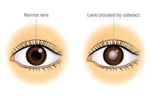 Cataract Surgery in the Bay Area