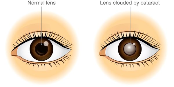 Cataract Surgery in the Bay Area