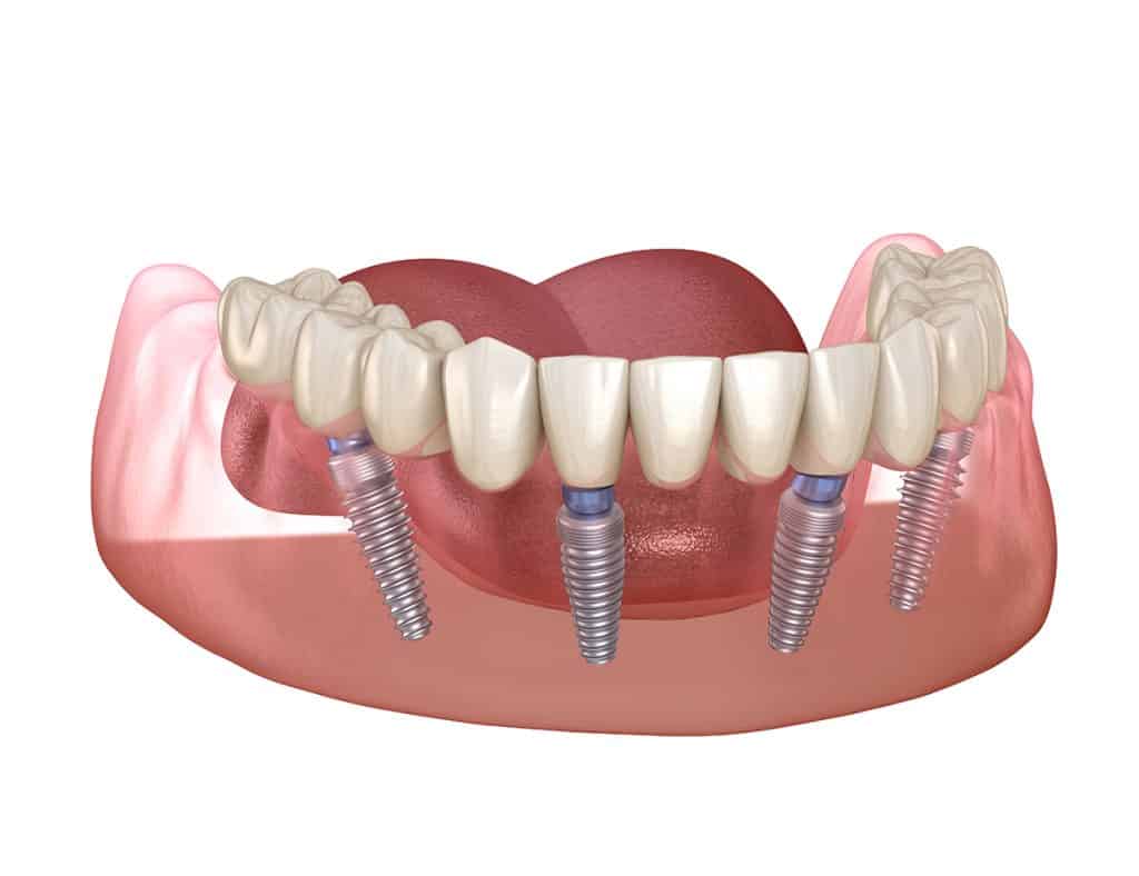 All-on-4 Implants & Partial Dentures Cincinnati, OH