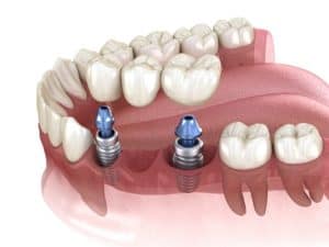 Dental Bone Graft Cincinnati, OH