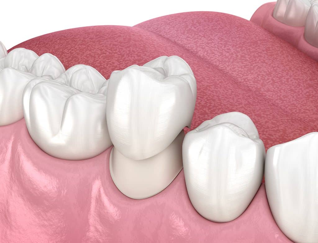 CEREC Same-Day Dental Crowns Cincinnati, OH