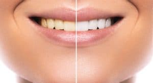 Professional Teeth Whitening Cincinnati OH