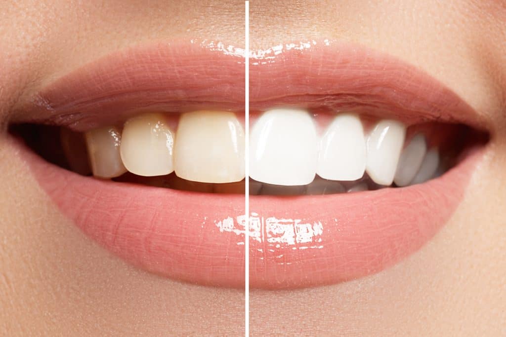 in-office teeth whitening