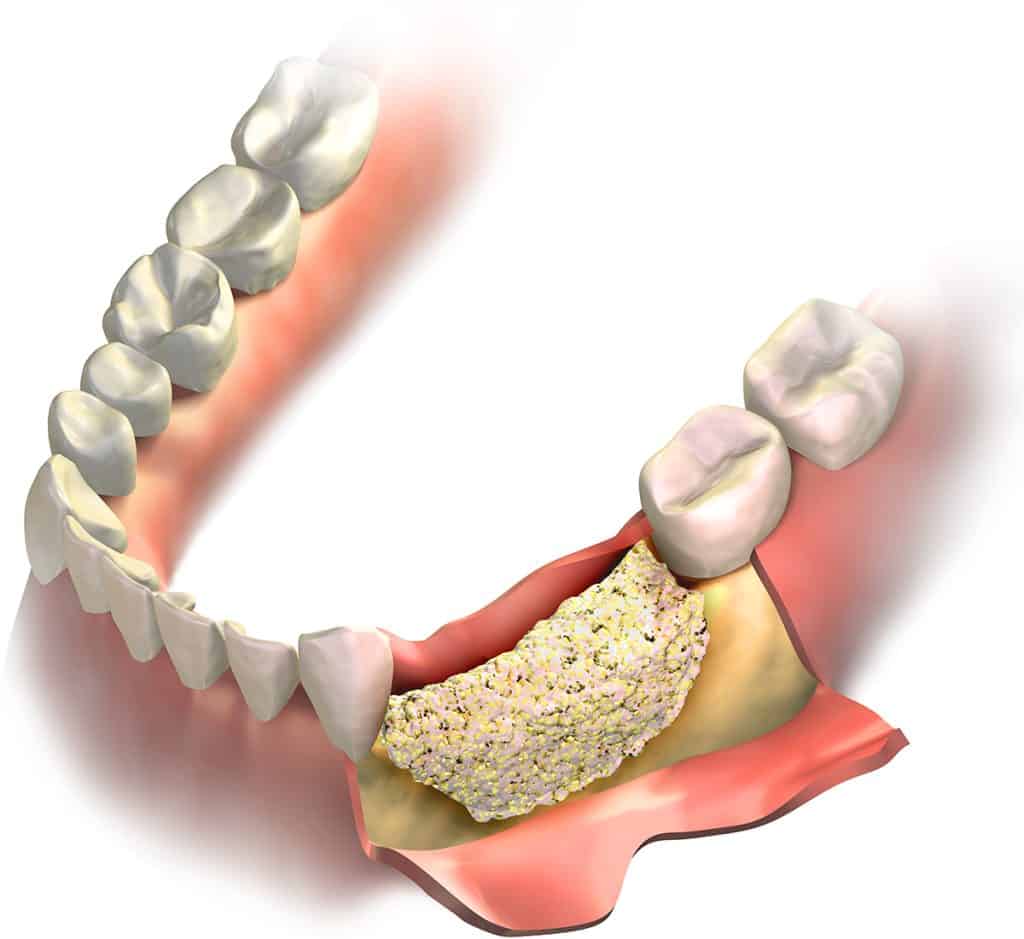 Bone Graft Cincinnati