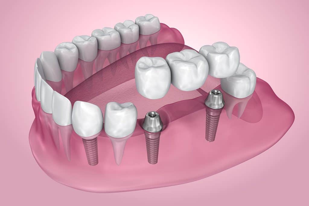 implant supported dentures cincinnati