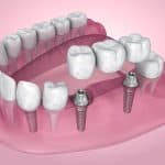implant supported dentures cincinnati