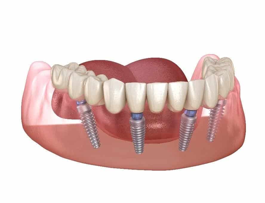 All-on-4 Implants in Seattle