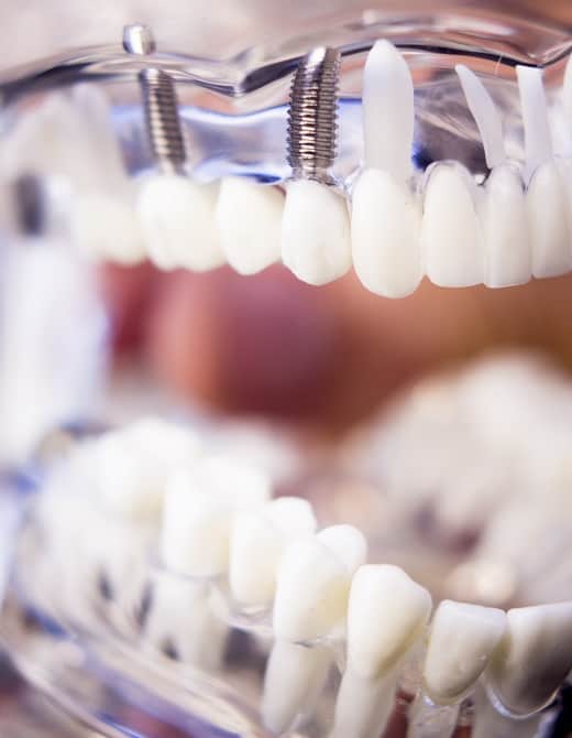 Dental Implant Timeline in Seattle