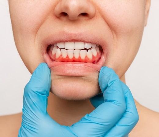 Gum Disease Care in Seattle
