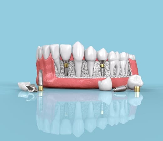 Dental Bone Loss Treatment in Seattle