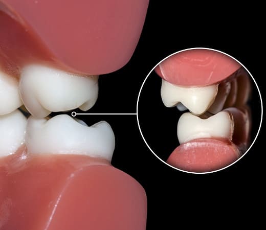 Bite Alignment Care in Seattle