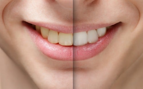 Smile whitening before and after