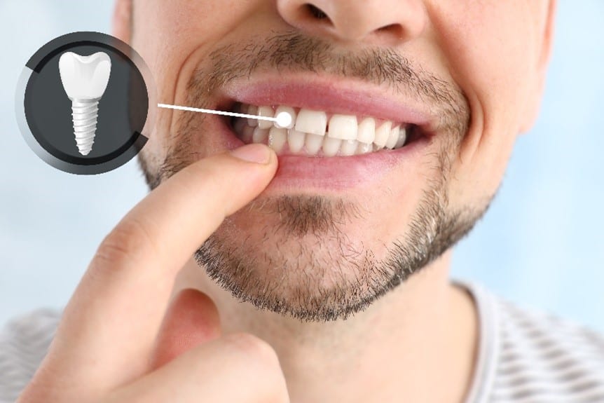 Dental Implants in Seattle and Kent, WA