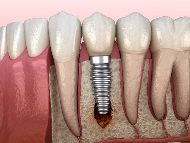 Peri-Implantitis in Seattle and Kent, WA