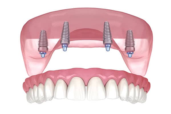 Implant supported Dentures Seattle