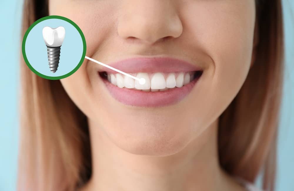 dental implants seattle