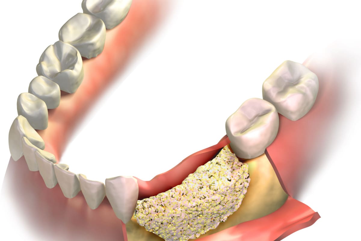 Dental bone grafting Seattle and Kent