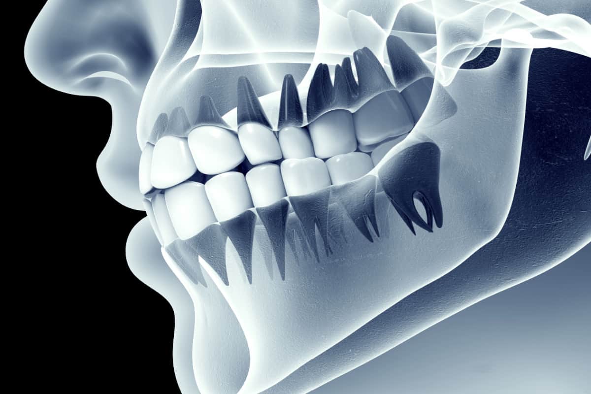 sinus augmentation results Kent 