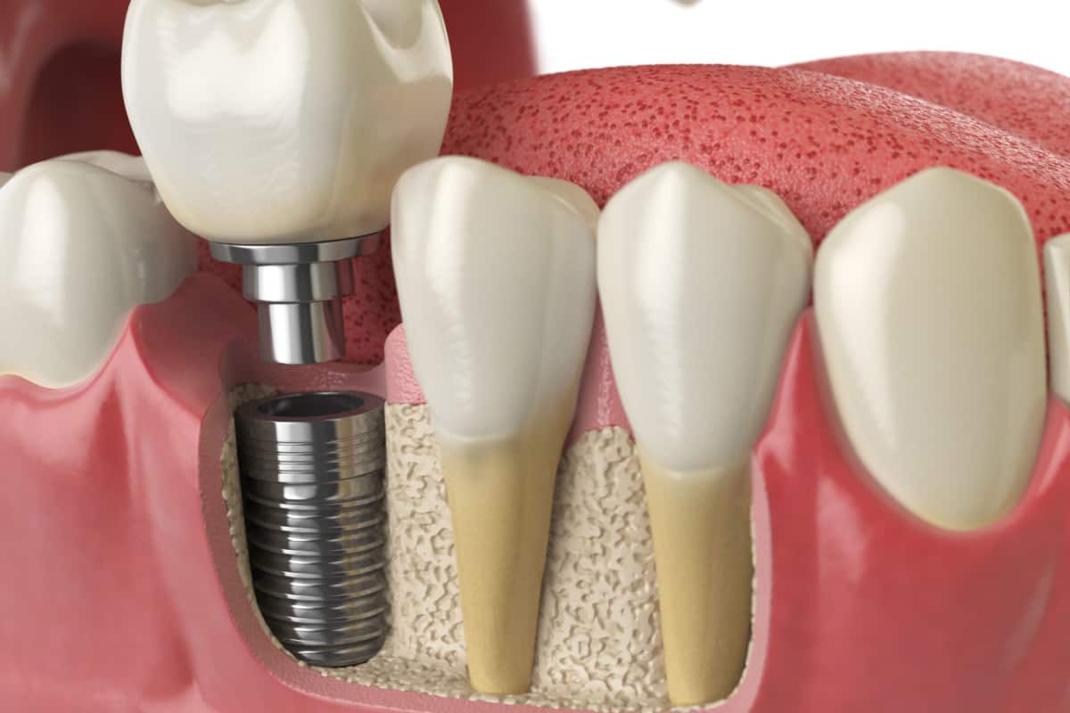 Dental Implants in Seattle