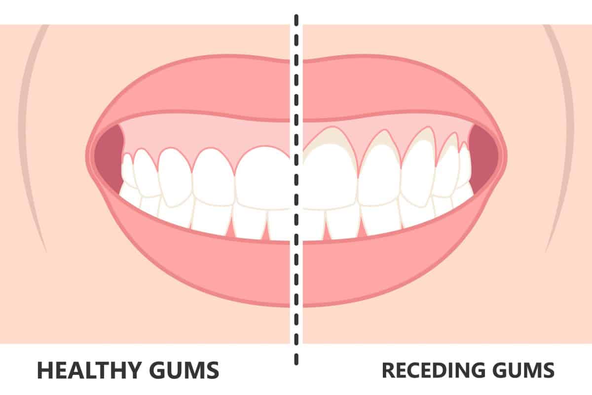 Gum recession treatment in Seattle