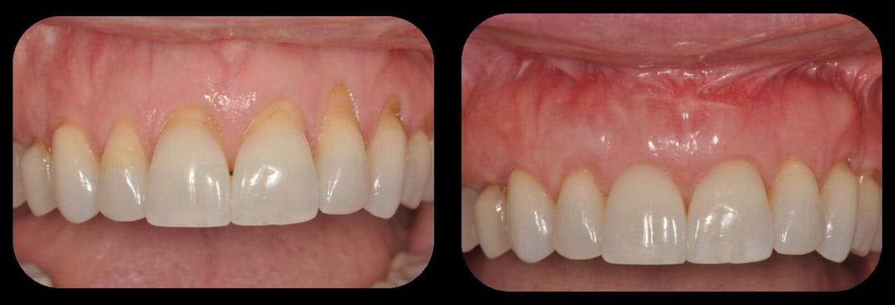 Soft Tissue Grafting in Seattle