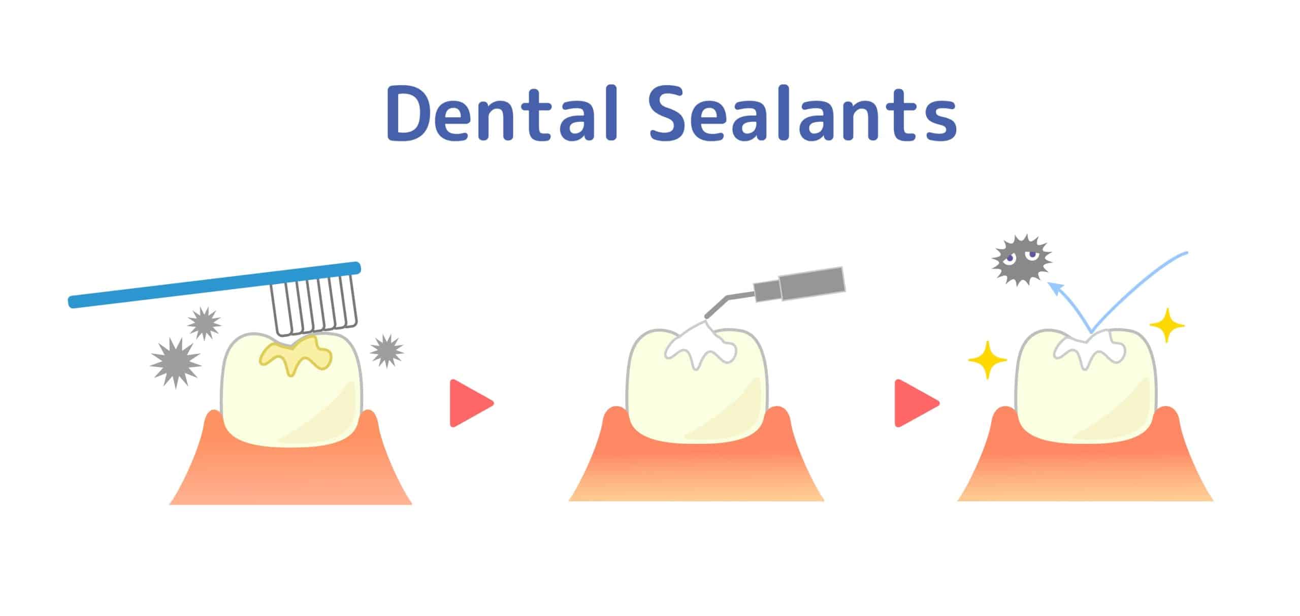 Should You Get Dental Sealants? Porter Dental Health Clinic