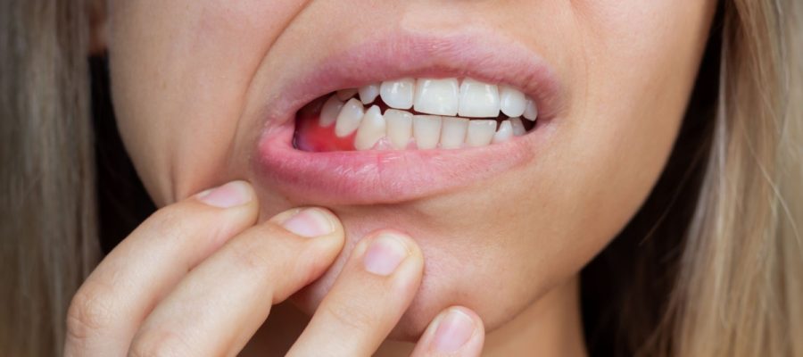 Gum Disease Sevierville