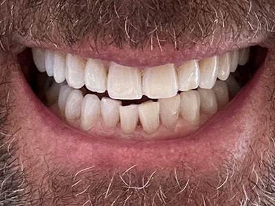 Zoom! tooth whitening