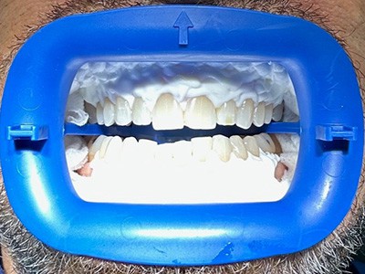 Zoom! tooth whitening