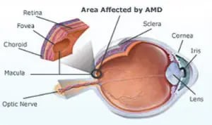 Age-Related Macular Degeneration (AMD) Treatment Largo Clearwater St Petersburg & Tampa FL