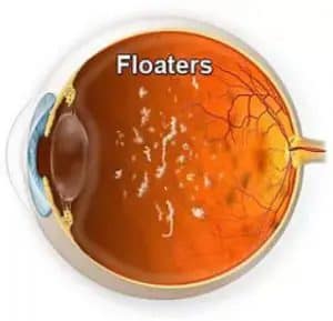 Eye Floater & Spot Treatment Largo, Clearwater, St Petersburg & Tampa FL
