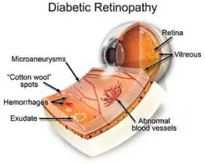 Diabetic Retinopathy Specialist Largo, Clearwater, & St Petersburg FL