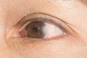 Pterygium Treatment for St. Petersburg & Clearwater, FL
