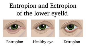 Eyelid Surgery for St. Petersburg & Clearwater, FL