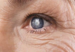 Cataract Surgery in Clearwater, FL