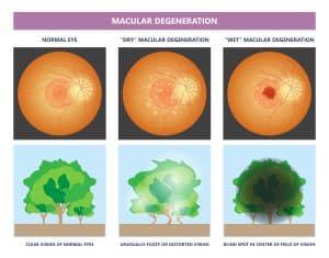 Macular Degeneration illustrated