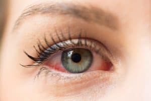 Dry Eye Treatment for St. Petersburg and Clearwater, FL