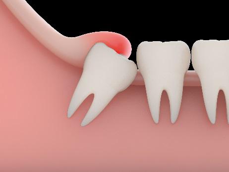 Wisdom Teeth Removal Portland