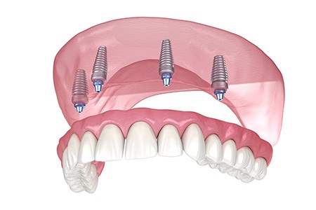 Full Mouth Restoration Tigard OR